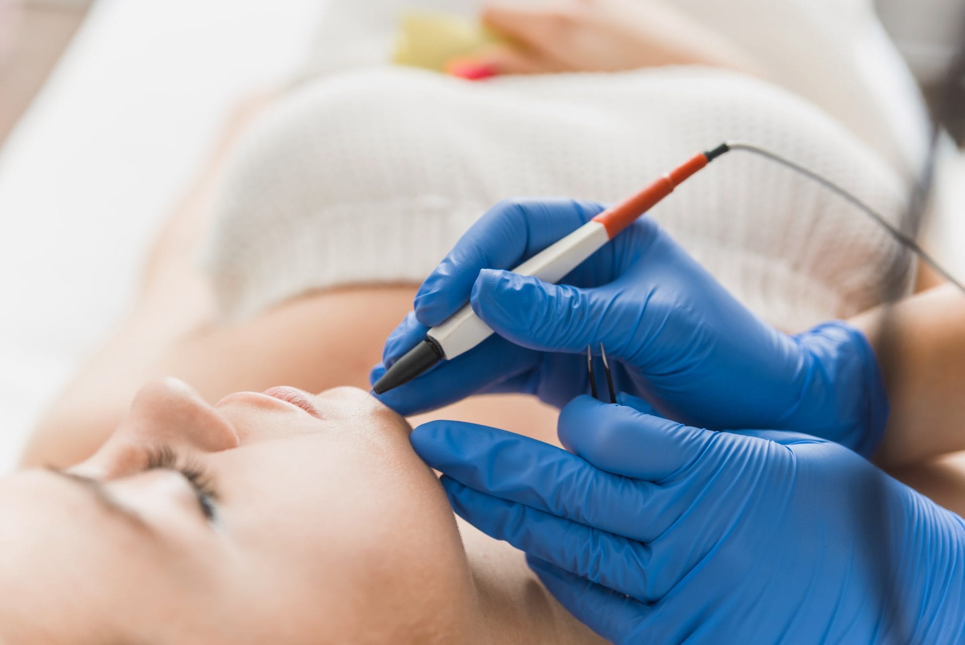 Close-up of an electrolysis probe treating fine upper-lip hair at Vale Laser Aesthetics