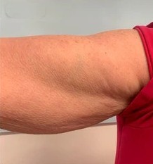 Before - Upper arm contouring