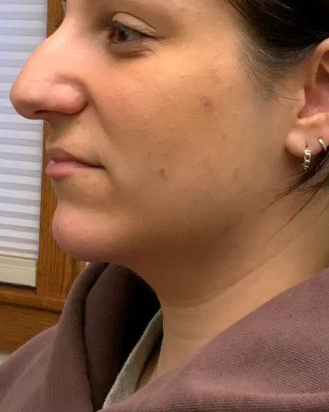 After - Double chin reduction