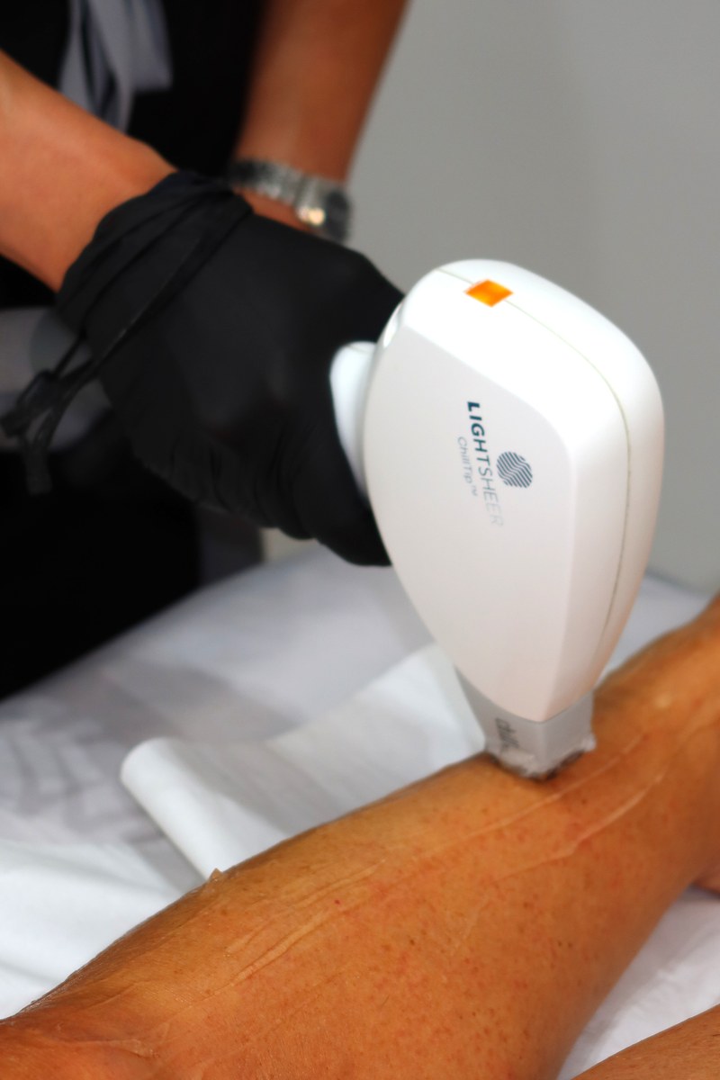 Close-up medical grade laser hair removal treatment on a client's forearm, showing the professional handpiece being used in clinic