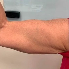 After - Upper arm contouring