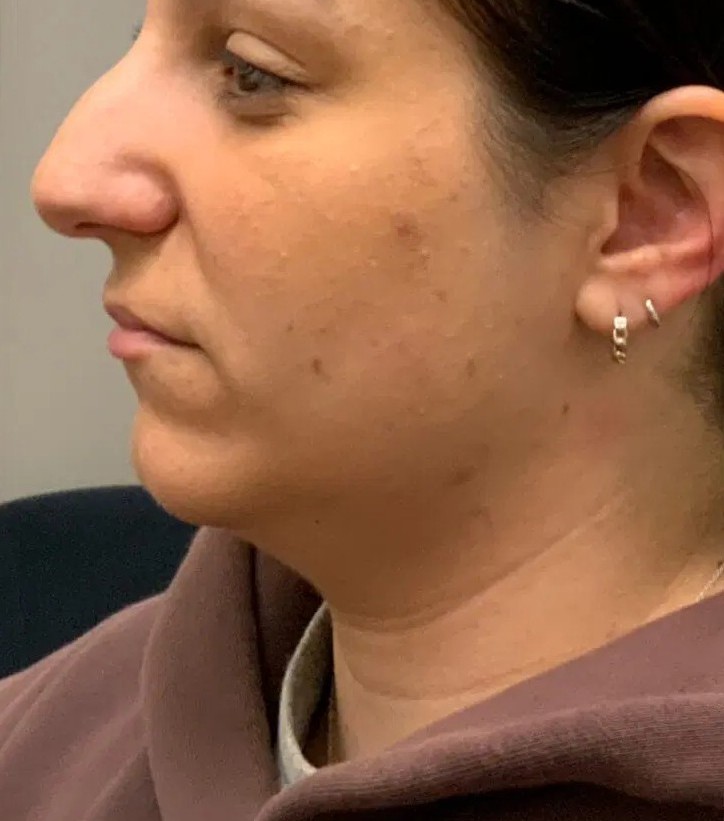 Before - Double chin reduction