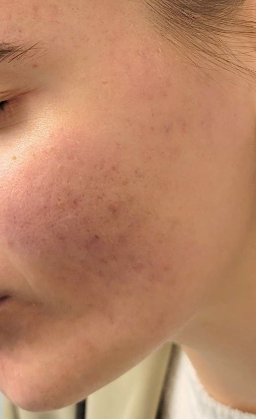 After - Active acne clearance