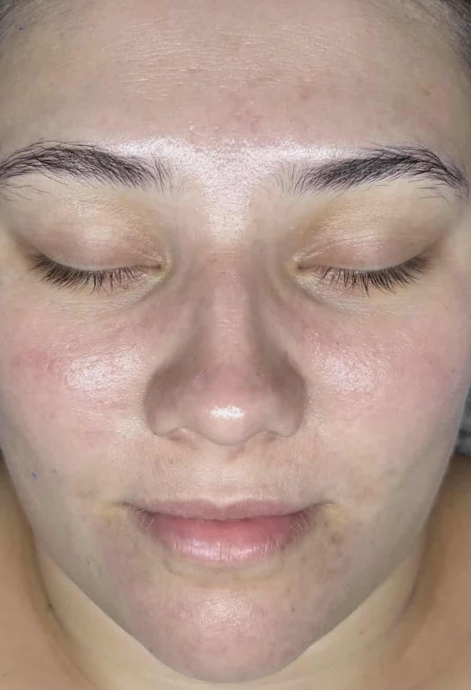 After - Full-face acne clearance