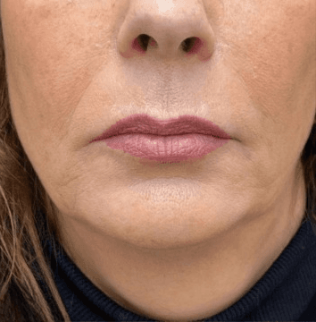 After - Lower face showing nasolabial folds and marionette lines