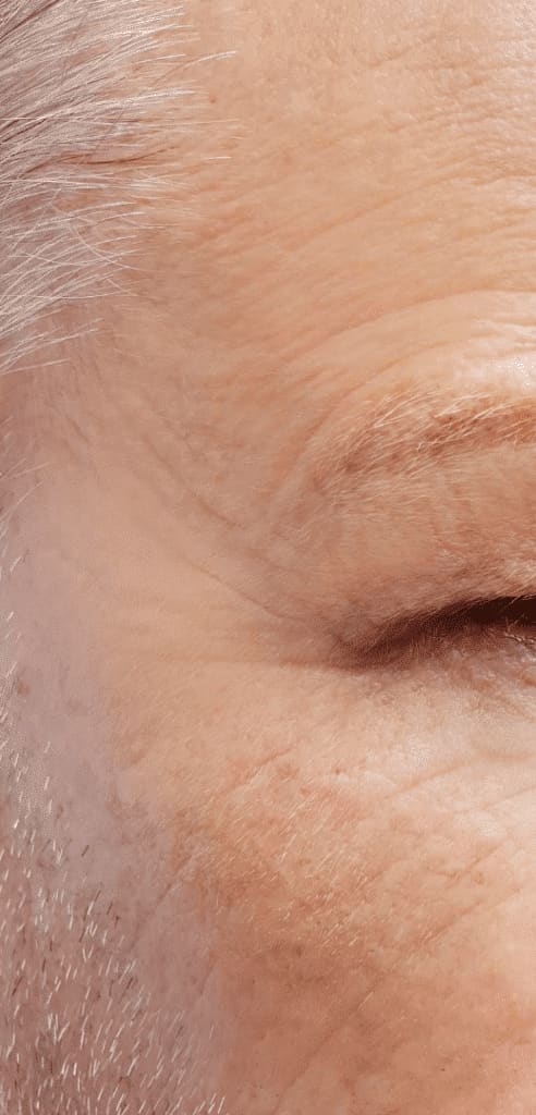 After - Crows feet wrinkles