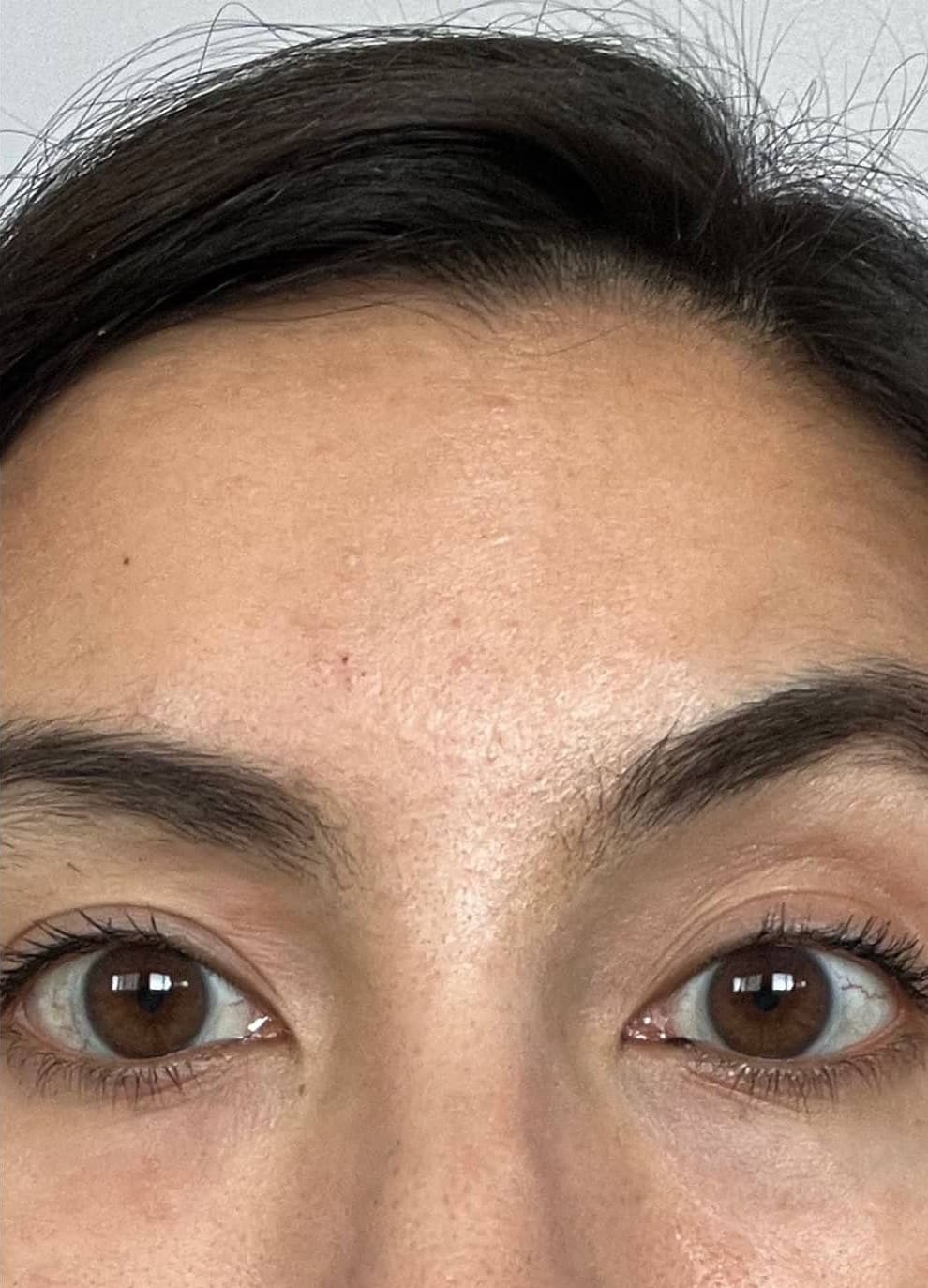 After - Forehead lines