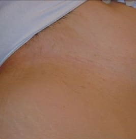 After - Female bikini line