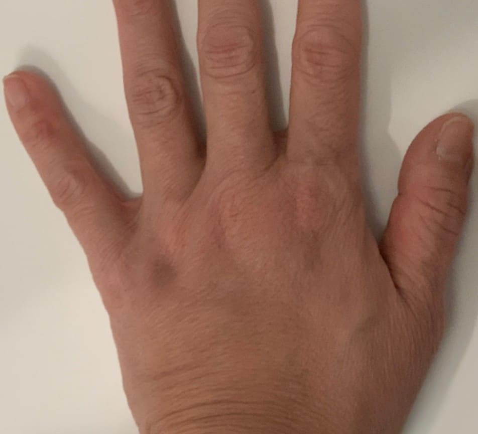 After - Hand rejuvenation