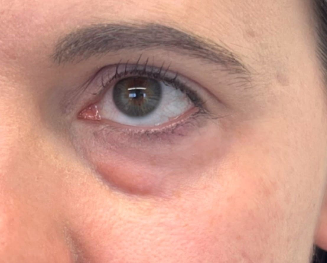 Before - Tear troughs (under-eye hollows)