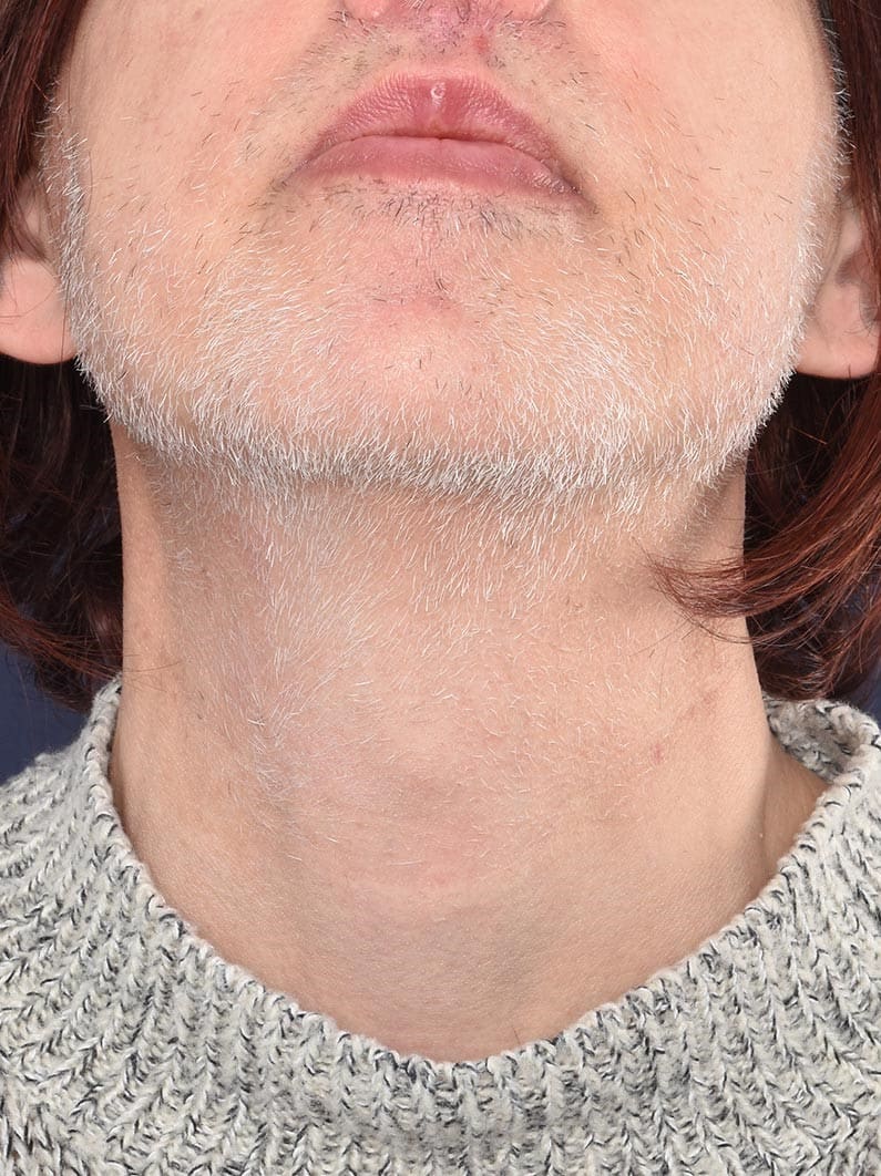 After - Chin and neck grey hair removal
