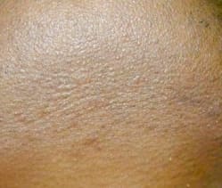 After - Female underarm