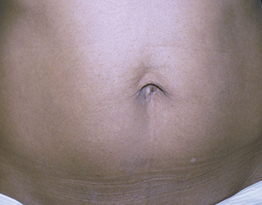 After - Abdominal skin tightening