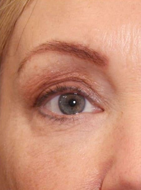 After - Eye area rejuvenation