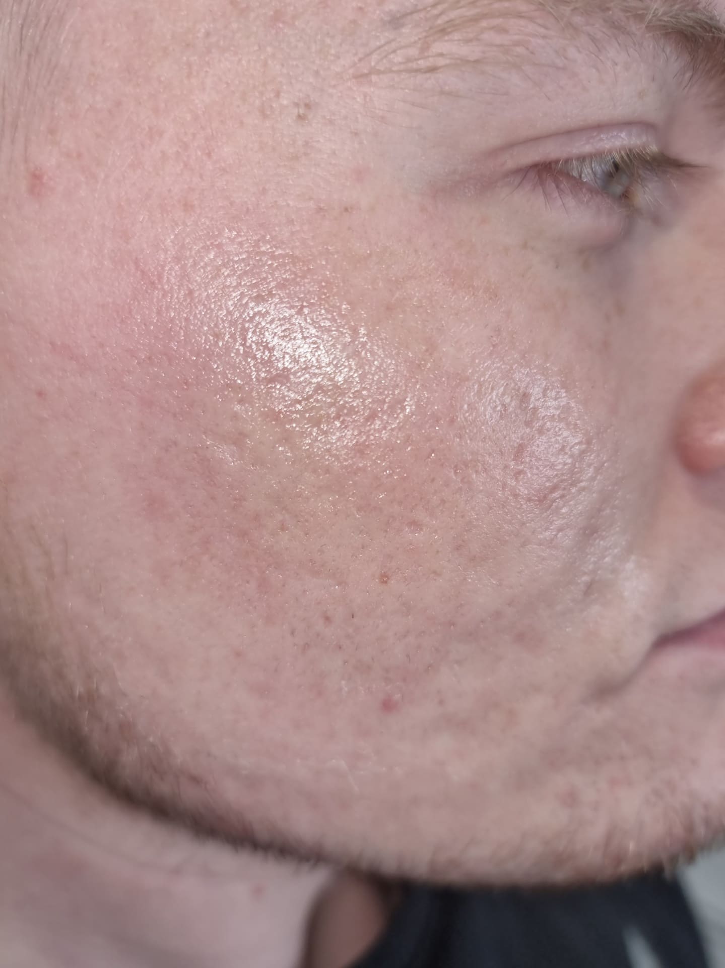 After - Acne scars and texture