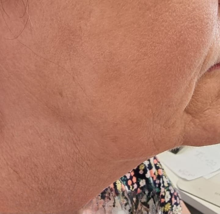 After - Sun damage and age spots
