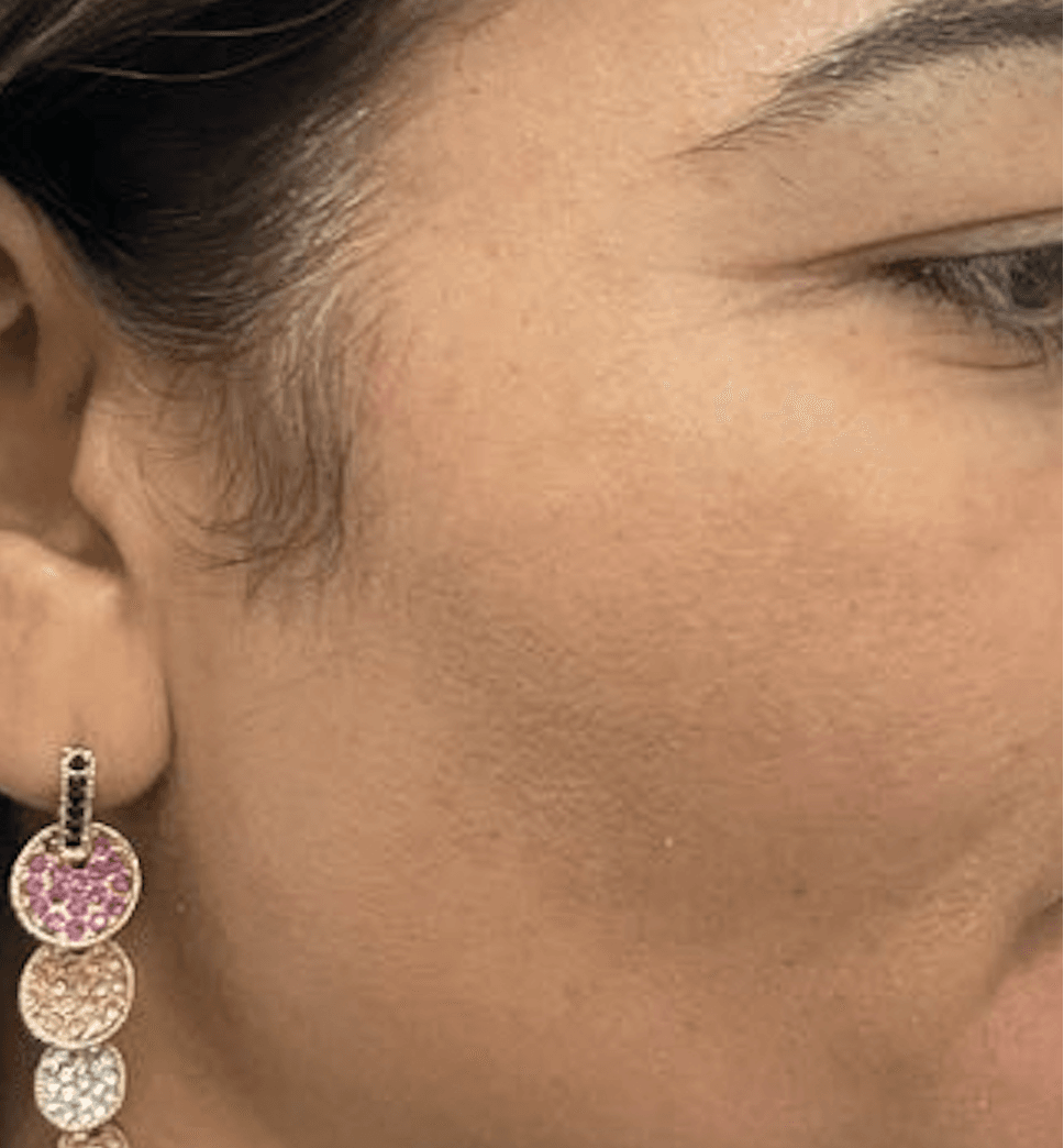 After - Uneven skin tone