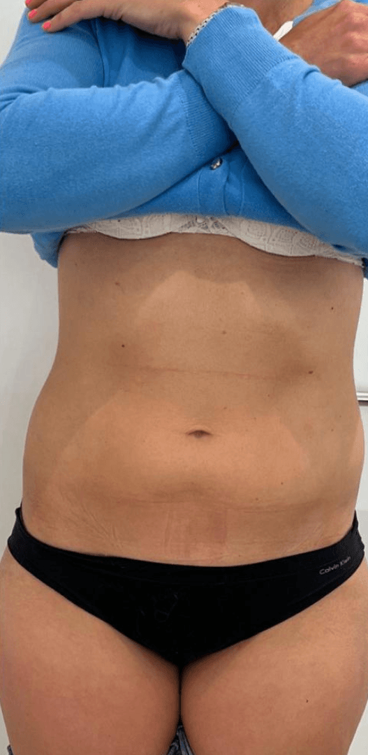 After - Abdominal skin tightening