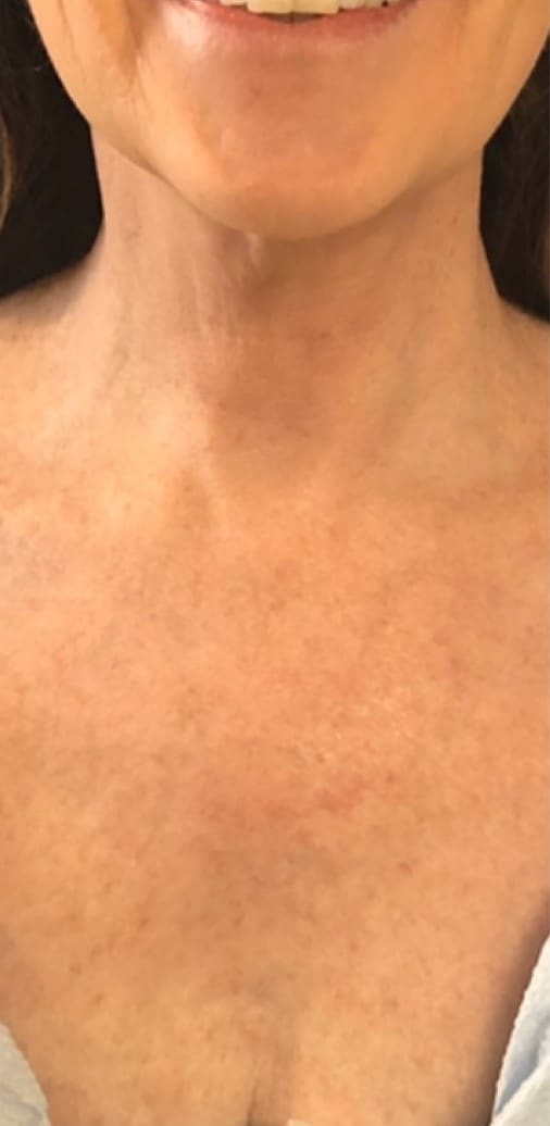 After - Décolletage tightening