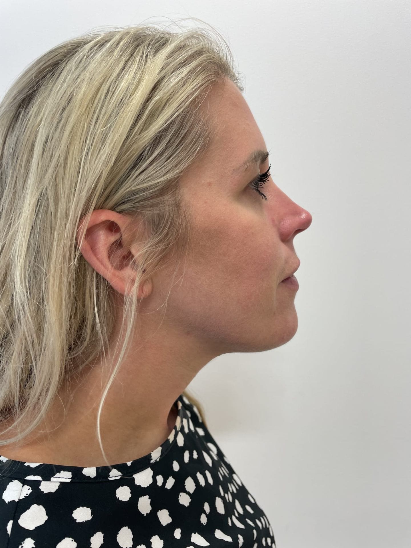 After - Jawline contouring