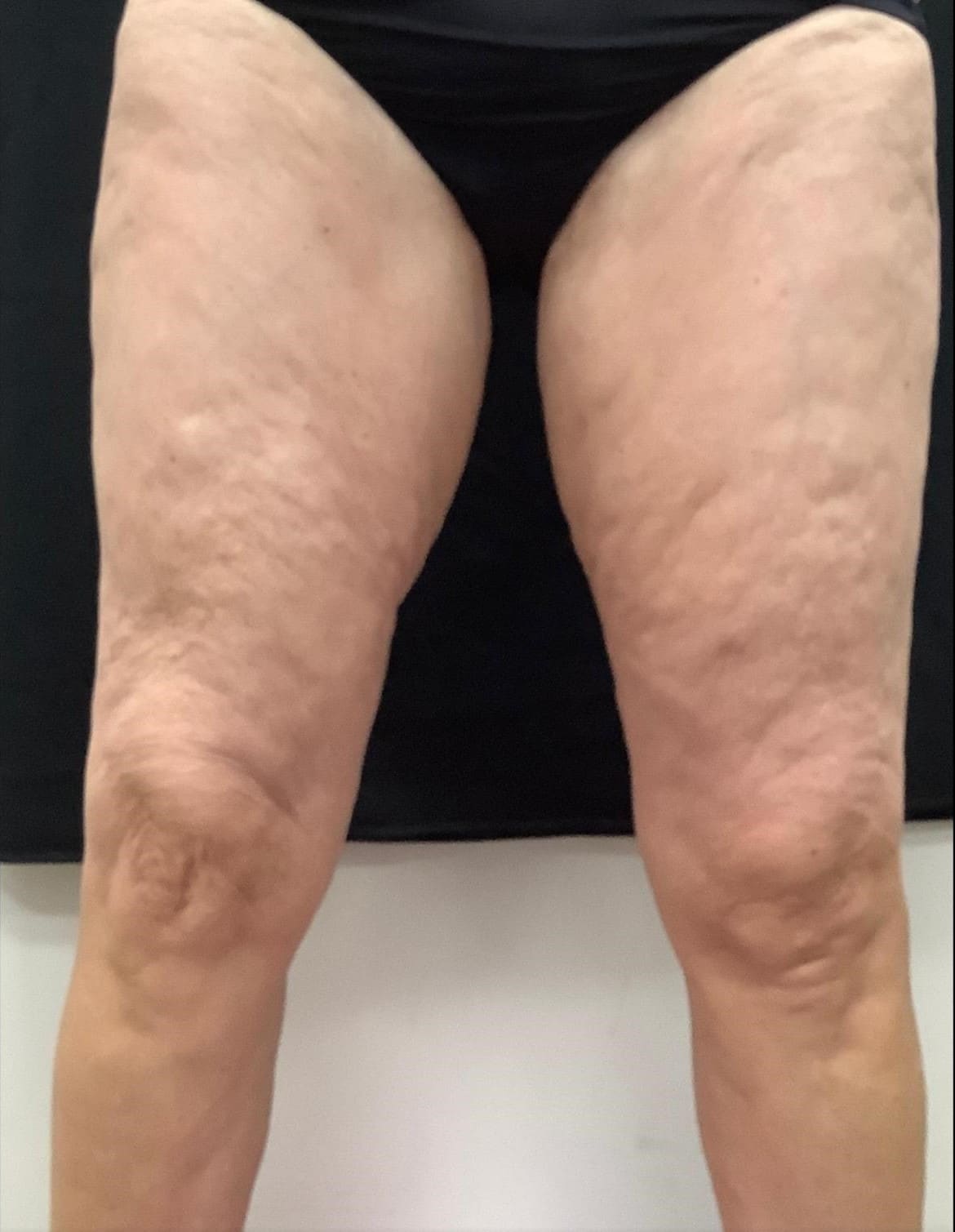 After - Body skin tightening