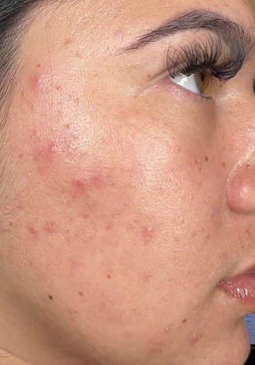 After - Platinum Hydrafacial