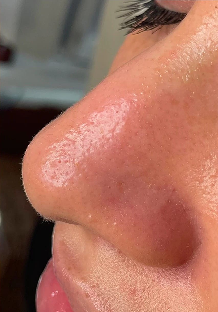 After - Signature Hydrafacial