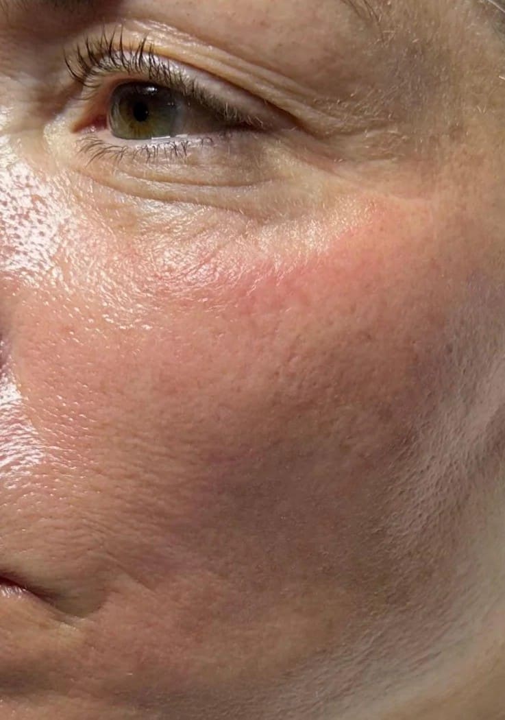After - Juvederm Volite treatment