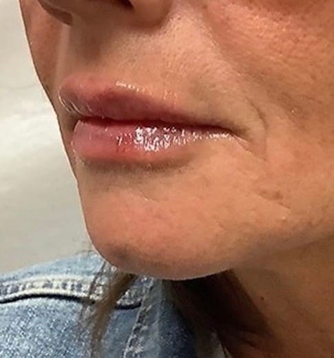 After - Asymmetry correction — visible improvement in lip balance