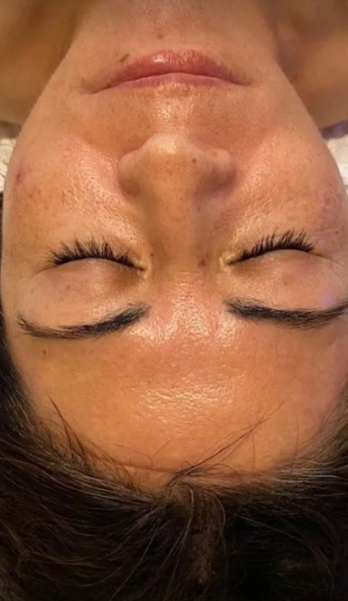 After - Smoother, more refined skin texture