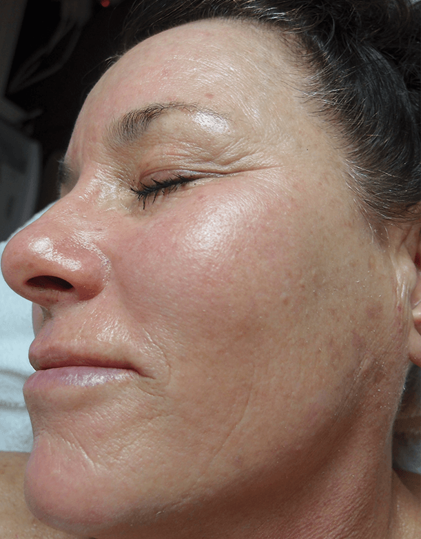 After - Brighter, smoother and more refined skin