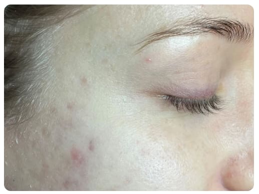 After - Acne Clearance