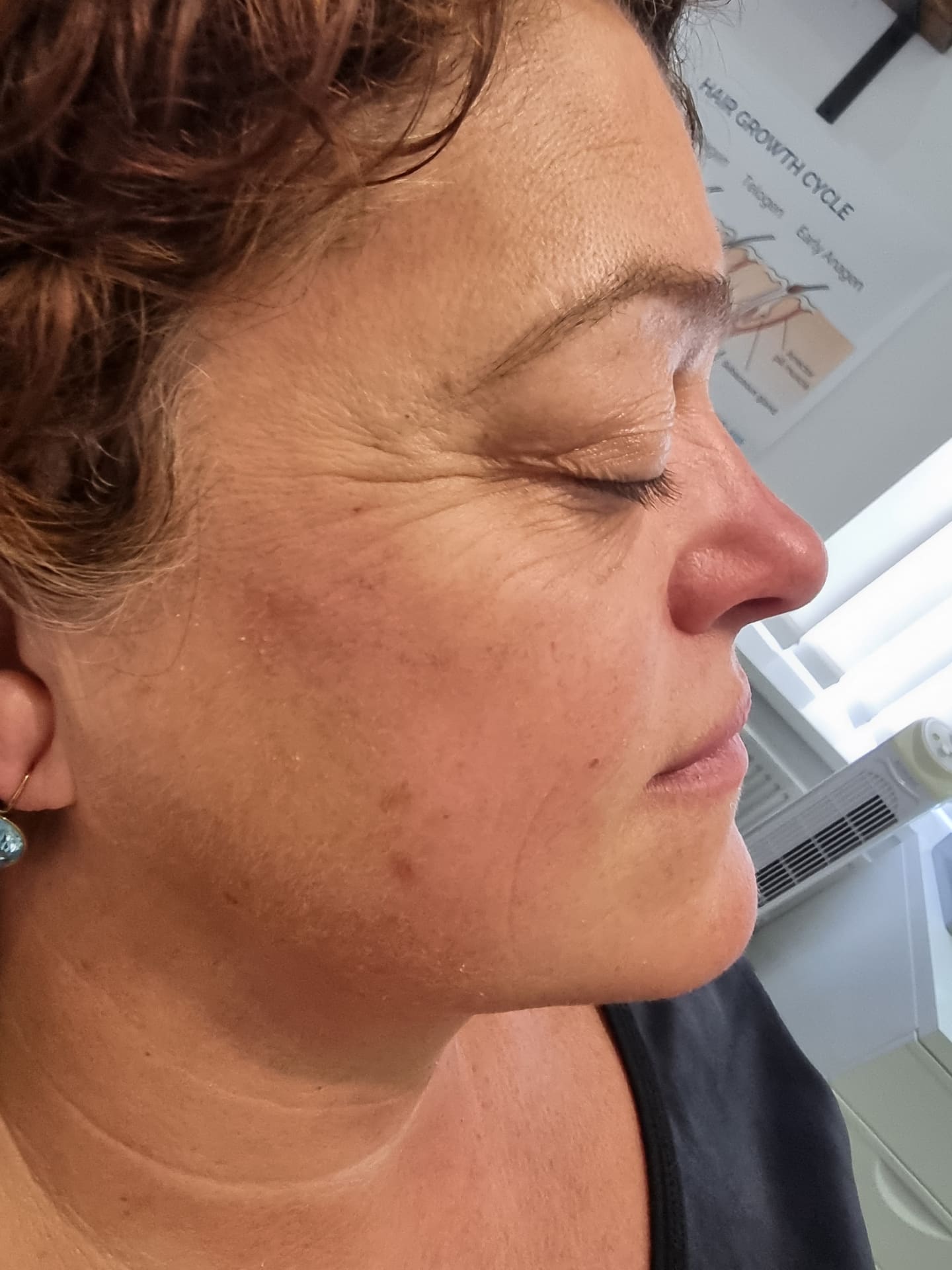 After - Skin Rejuvenation