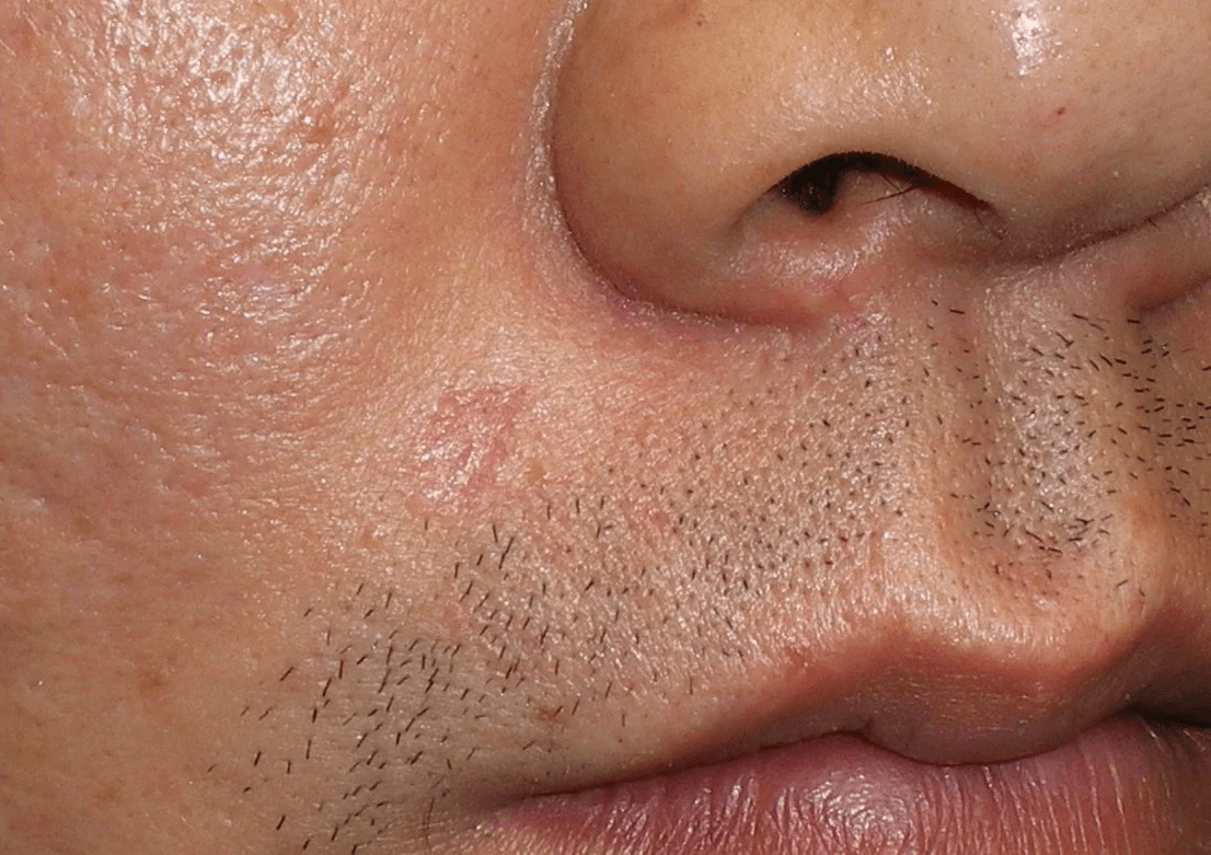 After - Lip Seborrheic Keratosis