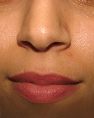After - Lip Seborrheic Keratosis