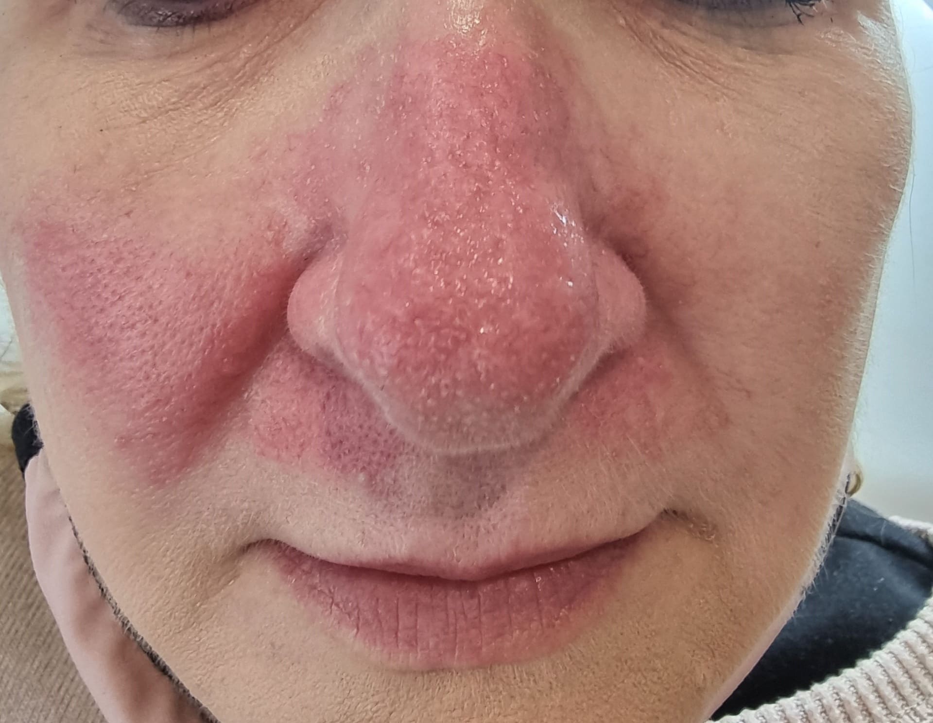 After - Nasal area thread vein removal