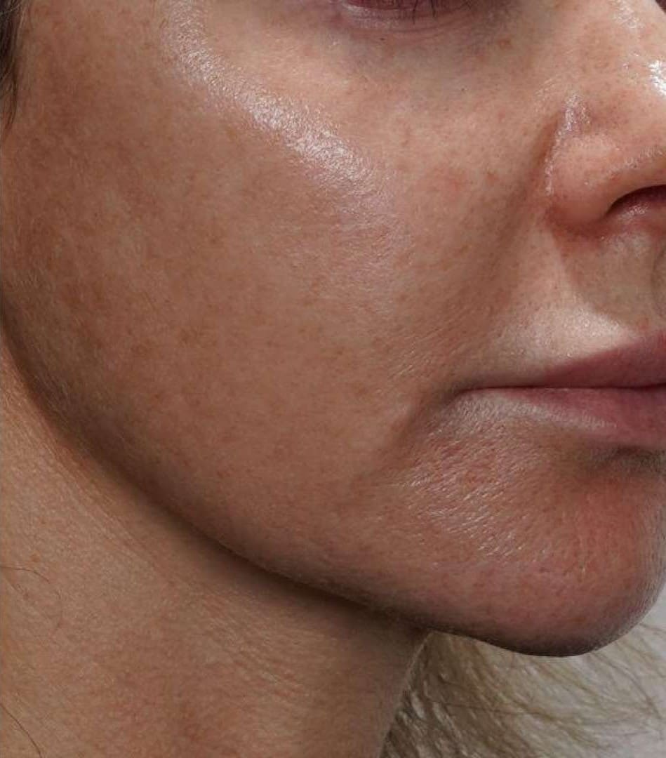 After - Freckles (Ephelides) + sun damage