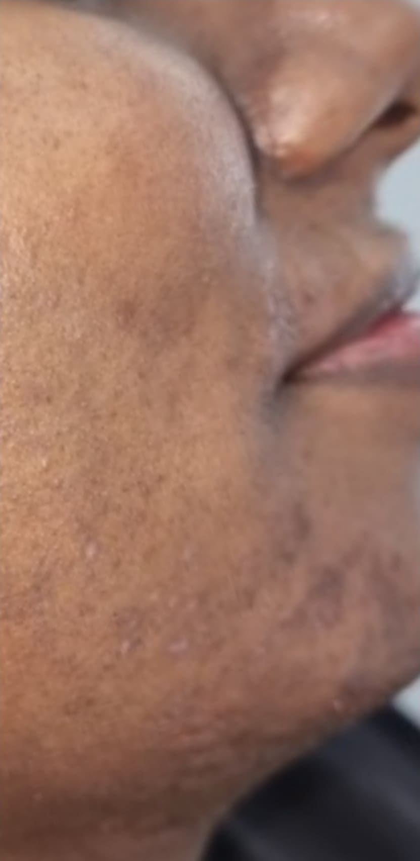 After - Post-Inflammatory Hyperpigmentation (PIH)