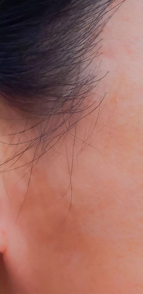 After - Sun damage & age spots