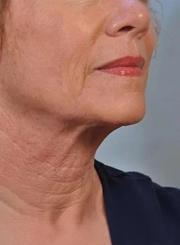 After - Profhilo treatment