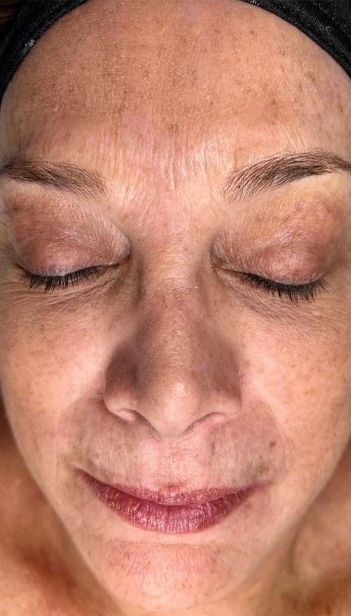 After - Seventy Hyal rejuvenation