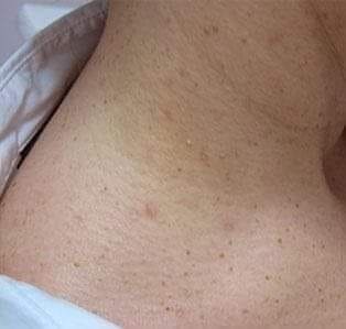 After - Neck Skin Tags (Acrochordons)
