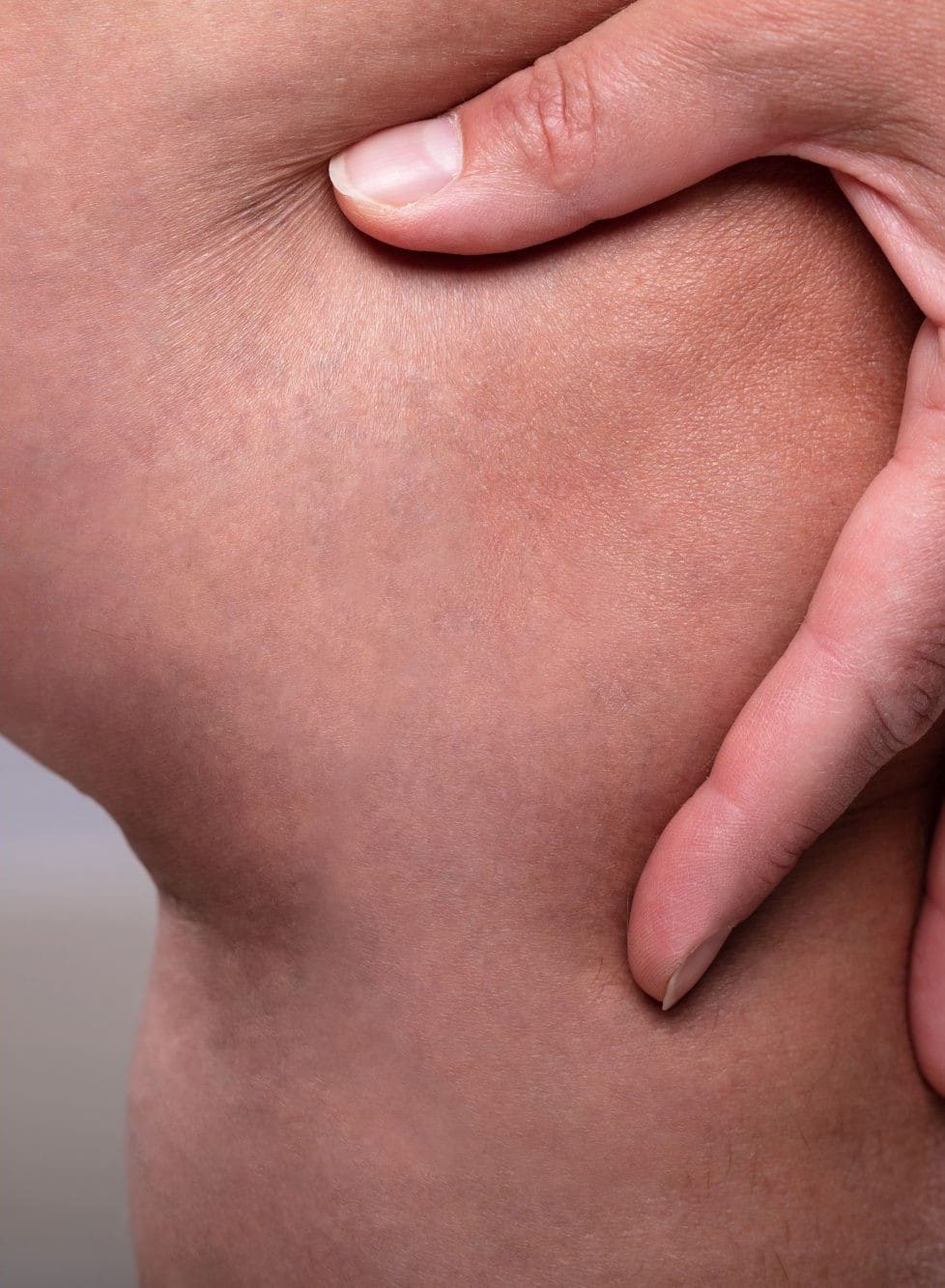 After - Thigh thread vein removal