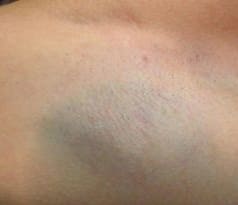After - Female underarm