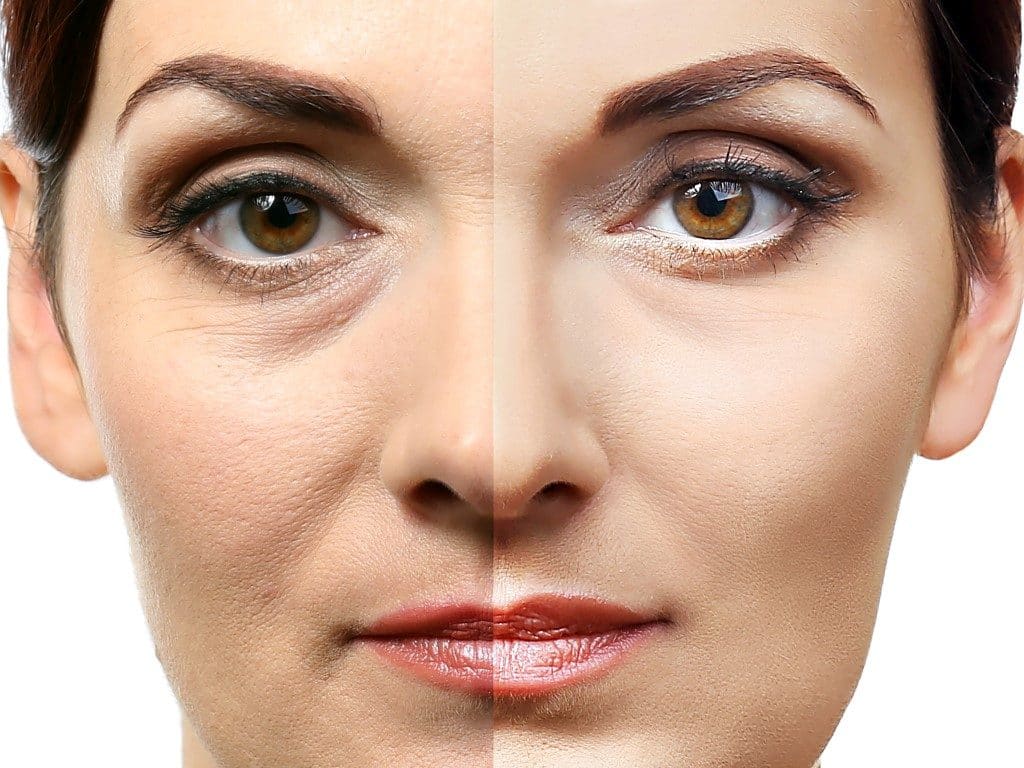 Before and after anti-wrinkle treatment comparison