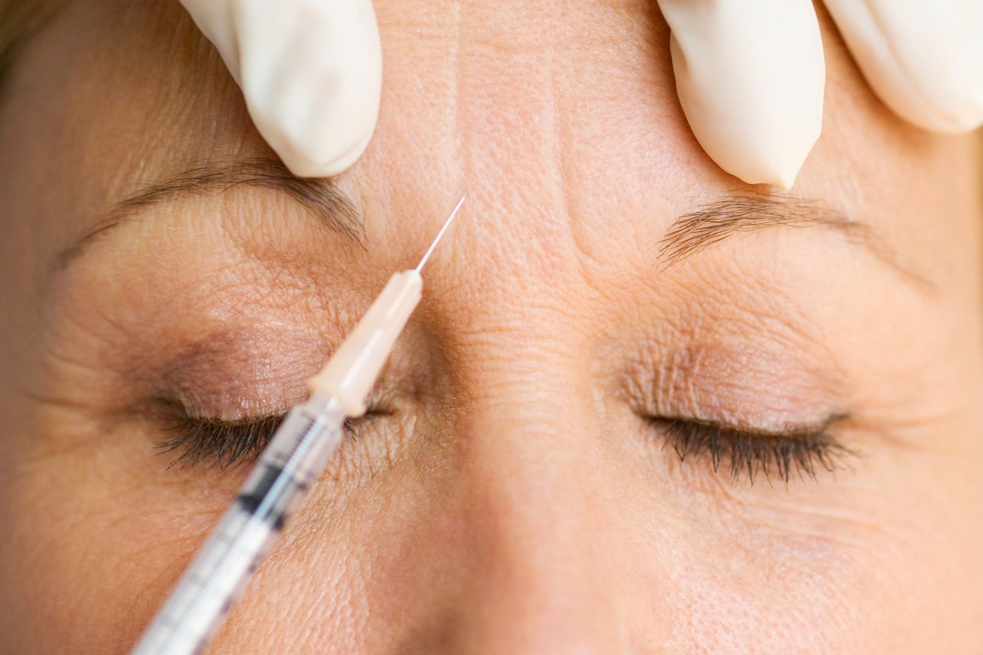 Anti-wrinkle injection treatment
