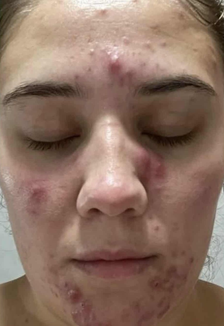 Before - Full-face acne clearance