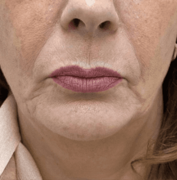 Before - Lower face showing nasolabial folds and marionette lines