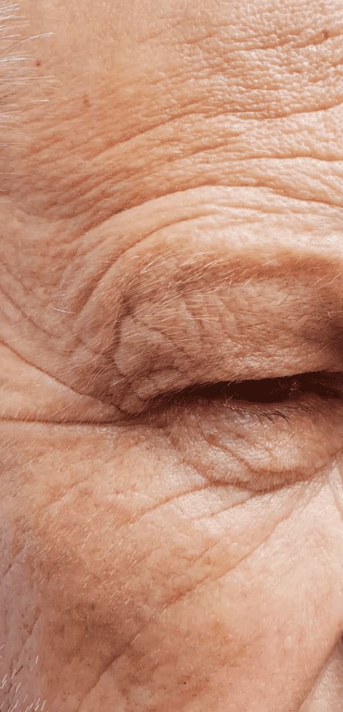 Before - Crows feet wrinkles