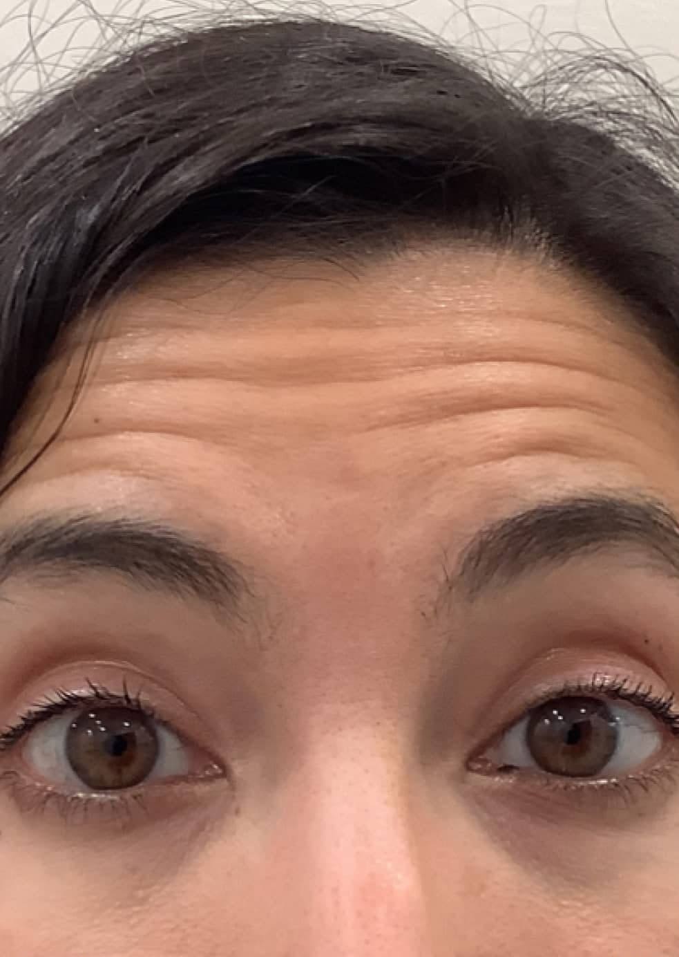 Before - Forehead lines